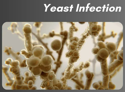 Microscopic view of yeast cells causing infection.