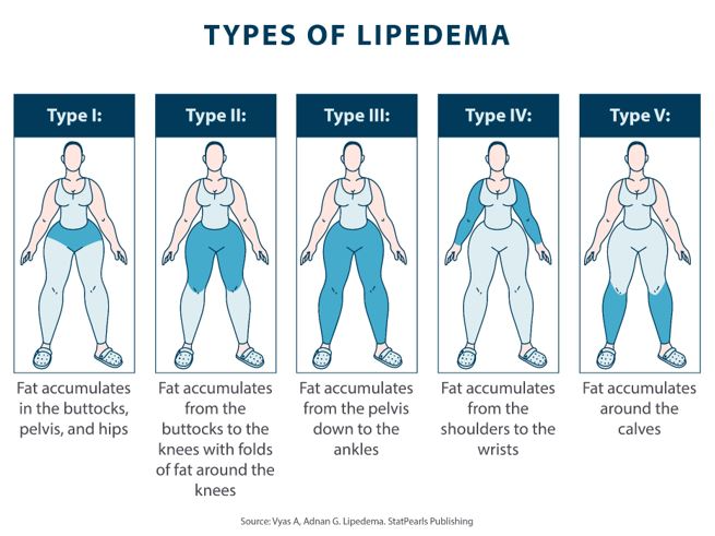 Illustration showing five types of lipedema.